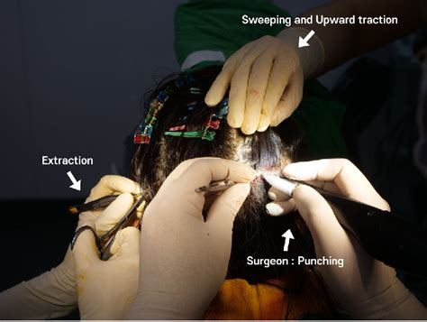 lcf hair transplant|Long hair follicular unit excision: personal experience .